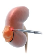 niere_gr_120831_verkleinert