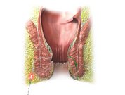 Analfistel_Laser_klein