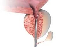 Prostata-Behandlung_mit_der_XCAVATOR-Faser_der_biolitec_